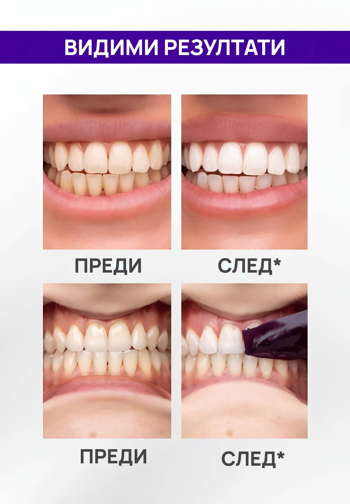V34 избелващи ленти за зъби